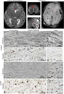 Post-mortem Characterisation of a Case With an ACTG1 Variant, Agenesis of the Corpus Callosum and Neuronal Heterotopia